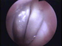 posterior commisure photo