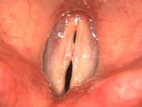 polyp and ectasia