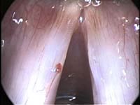 surgical view - polyp and ectasia