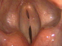 vocal polyp