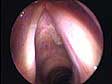 unilateral paralysis close up view