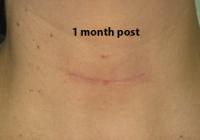 VoiceDoctor.net - Denervation-Reinnervation 01 - 1 month after surgery - frontal view