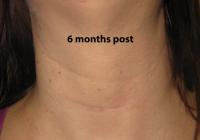 VoiceDoctor.net - Denervation-Reinnervation 01 - 6 months after surgery - frontal view