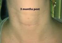 VoiceDoctor.net - Denervation-Reinnervation 01 - 3 months after surgery - frontal view