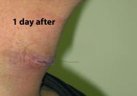 VoiceDoctor.net - Tracheal Reduction 03 - 1 day after - profile view