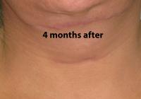 VoiceDoctor.net - Feminization Laryngoplasty 04 - 4 months after - frontal view