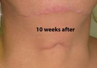 VoiceDoctor.net - Feminization Laryngoplasty 04 - 10 weeks after - frontal view