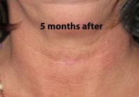 VoiceDoctor.net - Feminization Laryngoplasty 05 - 5 months after - frontal view