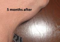 VoiceDoctor.net - Feminization Laryngoplasty 05 - 5 months after - profile view