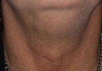 VoiceDoctor.net - Feminization Laryngoplasty 05 - before - frontal view