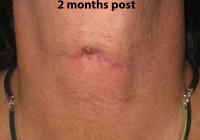 VoiceDoctor.net - Feminization Laryngoplasty 05 - 2 months after - frontal view