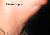 VoiceDoctor.net - Feminization Laryngoplasty 05 - 2 months after - profile view