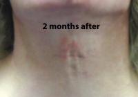 VoiceDoctor.net - Feminization Laryngoplasty 09 - 2 months after - front view