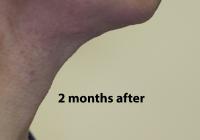 VoiceDoctor.net - Feminization Laryngoplasty 09 - 2 months after - profile view
