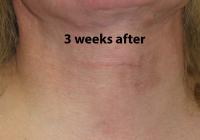 VoiceDoctor.net - Feminization Laryngoplasty 09 - 3 weeks after - front view