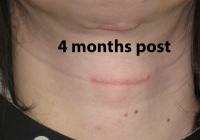 VoiceDoctor.net - Feminization Laryngoplasty 10 - 4 months post surgery - frontal view