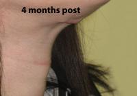 VoiceDoctor.net - Feminization Laryngoplasty 10 - 4 months post surgery - profile view