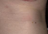 VoiceDoctor.net - Feminization Laryngoplasty 10 - before - frontal view