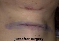 VoiceDoctor.net - Feminization Laryngoplasty 10 - same day, post surgery - frontal view