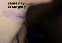 VoiceDoctor.net - Feminization Laryngoplasty 10 - same day, post surgery - profile view