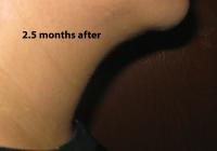 VoiceDoctor.net - Feminization Laryngoplasty 13 - 2.5 months after - profile view