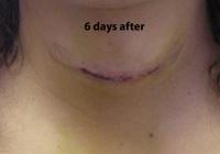VoiceDoctor.net - Feminization Laryngoplasty 13 - 6 days after - frontal view