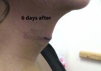 VoiceDoctor.net - Feminization Laryngoplasty 13 - 6 days after - profile view
