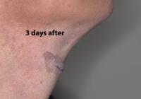 VoiceDoctor.net - Feminization Laryngoplasty 19 - 3 days after - profile view