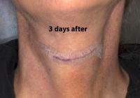 VoiceDoctor.net - Feminization Laryngoplasty 19 - 3 days after - frontal view