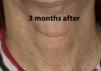 VoiceDoctor.net - Feminization Laryngoplasty 20 - 3 months after - frontal view