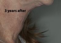 VoiceDoctor.net - Feminization Laryngoplasty 20 - 3 years after - profile view