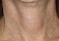 VoiceDoctor.net - Feminization Laryngoplasty 20 - before - frontal view