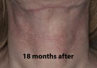 VoiceDoctor.net - Feminization Laryngoplasty 21 - 18 months after - front view