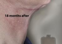 VoiceDoctor.net - Feminization Laryngoplasty 21 - 18 months after - profile view
