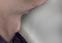 VoiceDoctor.net - Feminization Laryngoplasty 21 - before - profile view