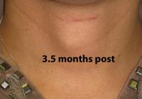 VoiceDoctor.net - Feminization Laryngoplasty 27 - 3.5 months after - frontal view