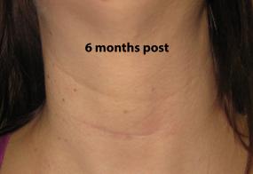 VoiceDoctor.net - Denervation-Reinnervation 01 - 6 months after surgery - frontal view