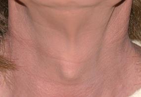 VoiceDoctor.net - Tracheal Reduction 01 - before - frontal view