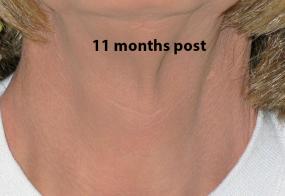 VoiceDoctor.net - Tracheal Reduction 01 - 11 months after - frontal view