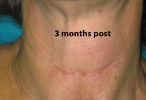 VoiceDoctor.net - Denervation-Reinnervation 02 - 3 months after - frontal view