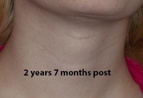 VoiceDoctor.net - Feminization Laryngoplasty 02 - 2 years 7 months after - frontal view