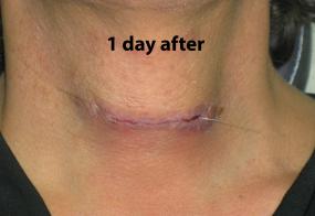 VoiceDoctor.net - Tracheal Reduction 03 - 1 day after - frontal view