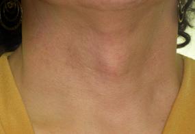 VoiceDoctor.net - Tracheal Reduction 03 - before - frontal view