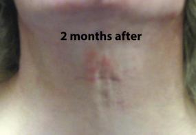 VoiceDoctor.net - Feminization Laryngoplasty 09 - 2 months after - front view