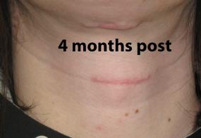 VoiceDoctor.net - Feminization Laryngoplasty 10 - 4 months post surgery - frontal view