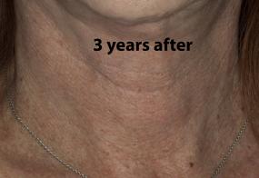 VoiceDoctor.net - Feminization Laryngoplasty 20 - 3 years after - frontal view