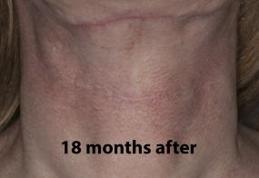 VoiceDoctor.net - Feminization Laryngoplasty 21 - 18 months after - front view