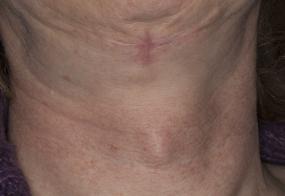 VoiceDoctor.net - Feminization Laryngoplasty 21 - before - frontal view