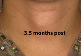 VoiceDoctor.net - Feminization Laryngoplasty 27 - 3.5 months after - frontal view