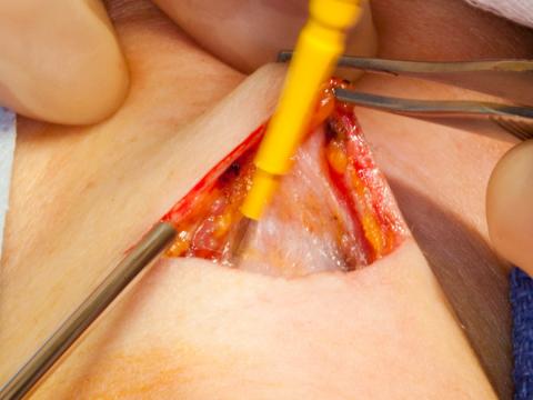Feminization laryngoplasty elevating flaps